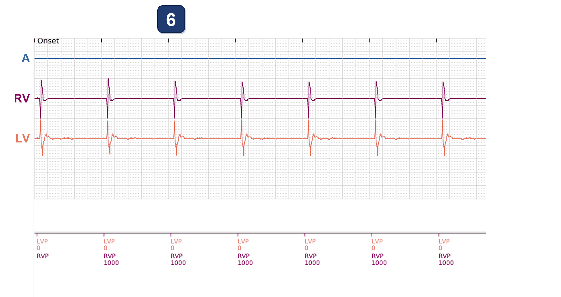 Électrogramme Boston Scientific CRT, segment 3/7 — Alerte d'impédance VG hors limites en fin de vie de pile