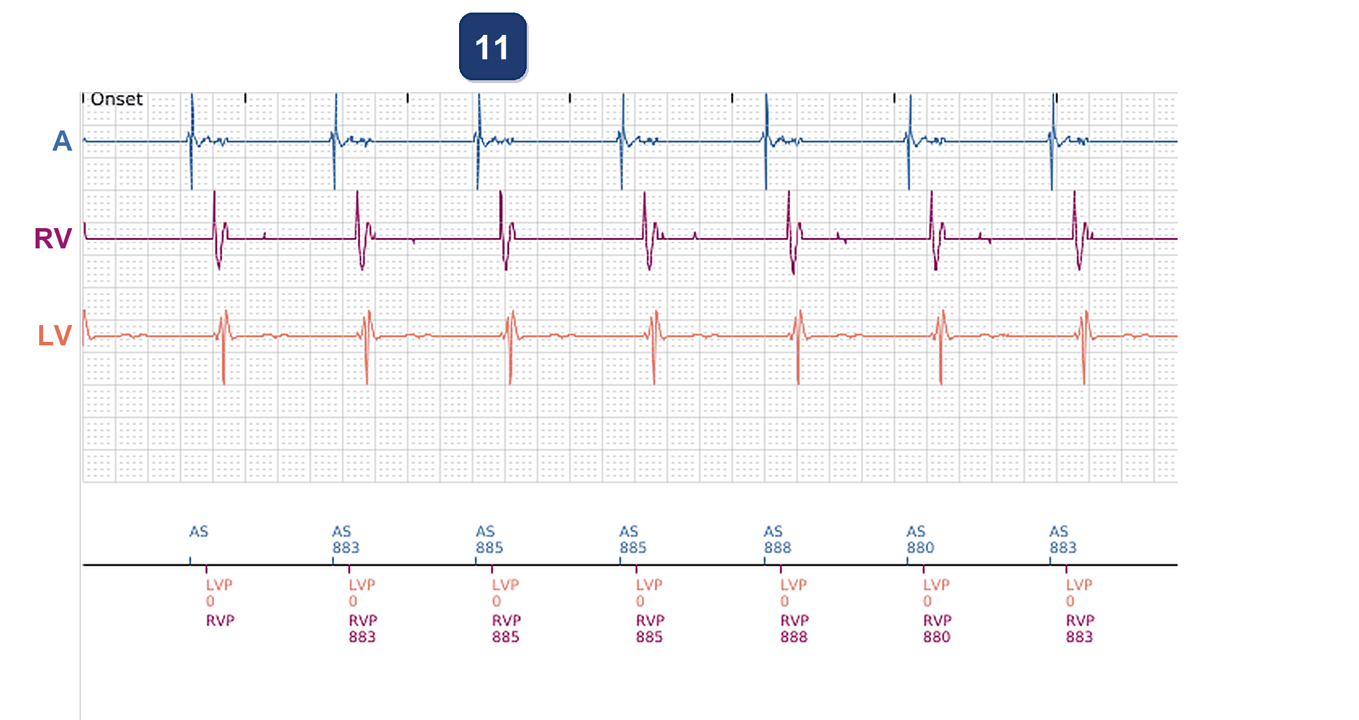 Électrogramme Boston Scientific CRT, segment 7/7 — Saut d'impédance VG après une consultation