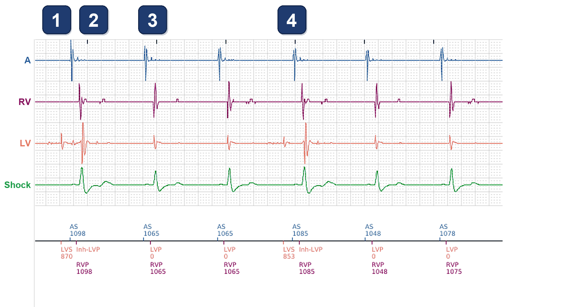 Électrogramme Boston Scientific CRT, segment 1/4 — Battements intermittents stimulés en VD seul chez un CRT-D RESONATE