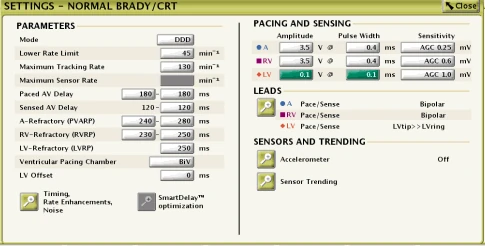 Écran du programmateur, Settings – Normal Brady/CRT (un exemple) : sous LEADS se règle la configuration de stimulation et de détection de chaque sonde ; on peut y changer le vecteur de détection VG, et même désactiver la détection VG