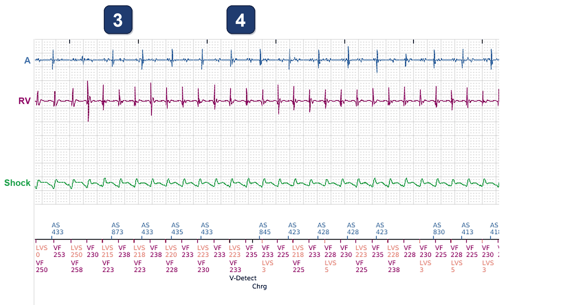 Électrogramme Boston Scientific CRT, segment 2/3 — Choc d'un CRT-D : et le canal VG ?