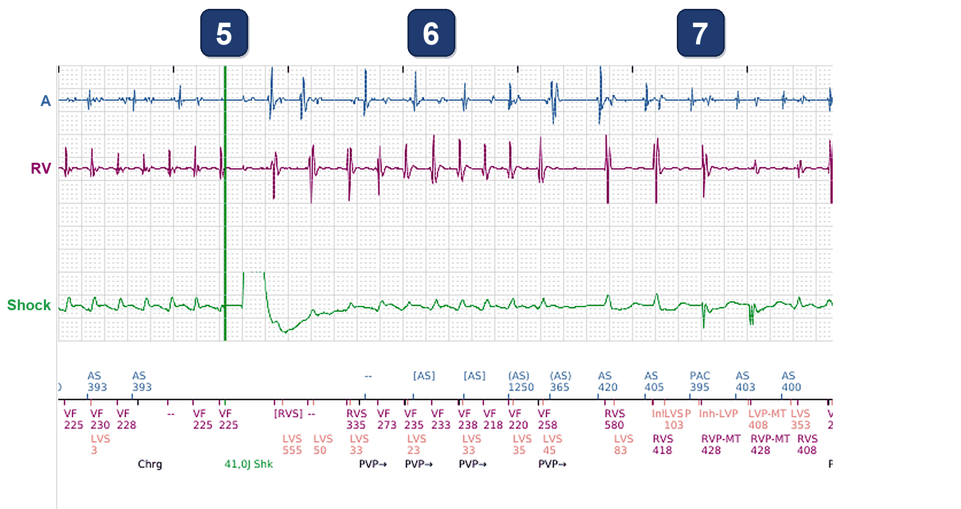 Électrogramme Boston Scientific CRT, segment 3/3 — Choc d'un CRT-D : et le canal VG ?