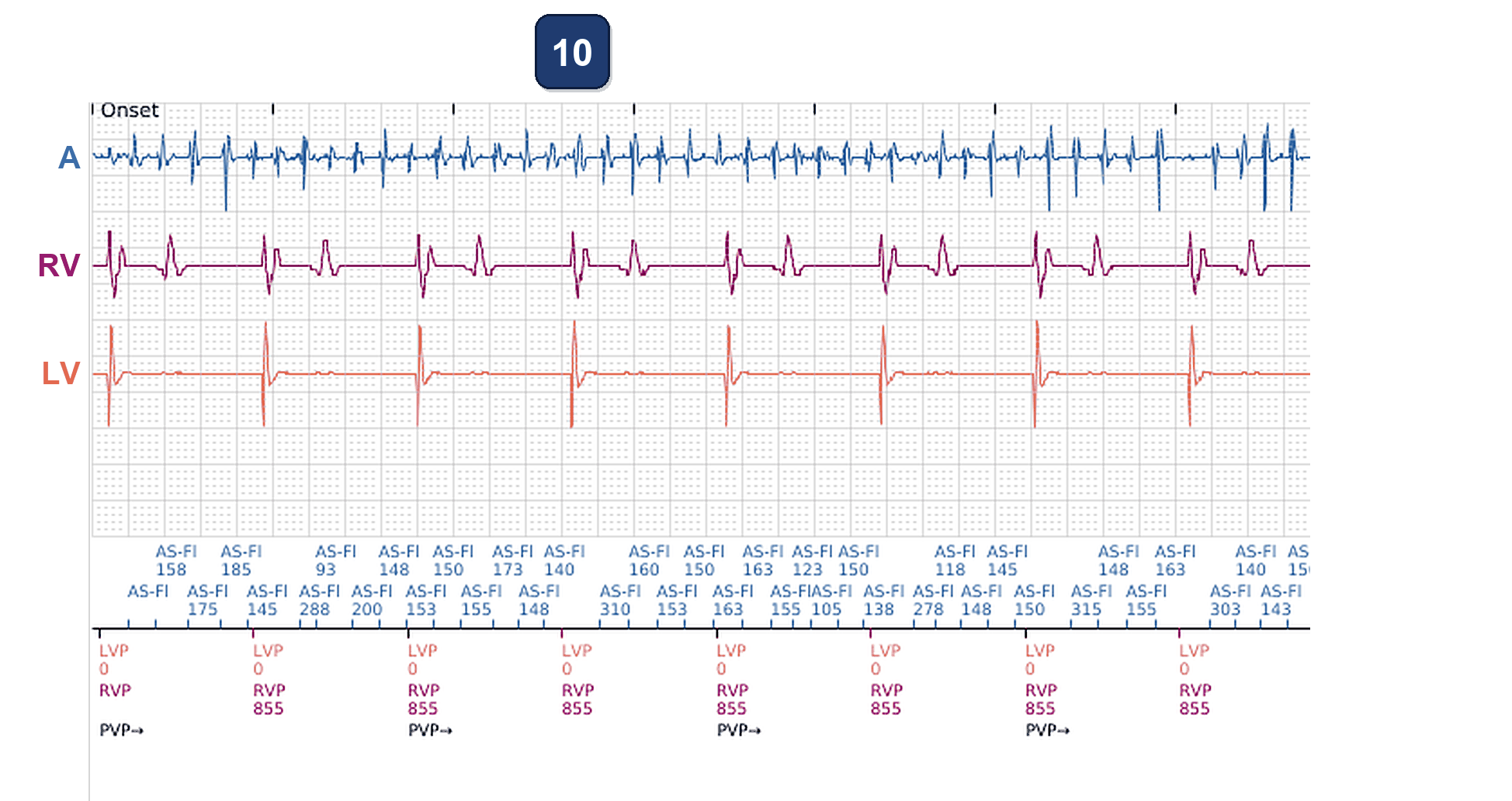 Électrogramme Boston Scientific CRT, segment 5/5 — CRT-P en FA : deux pourcentages de stimulation différents
