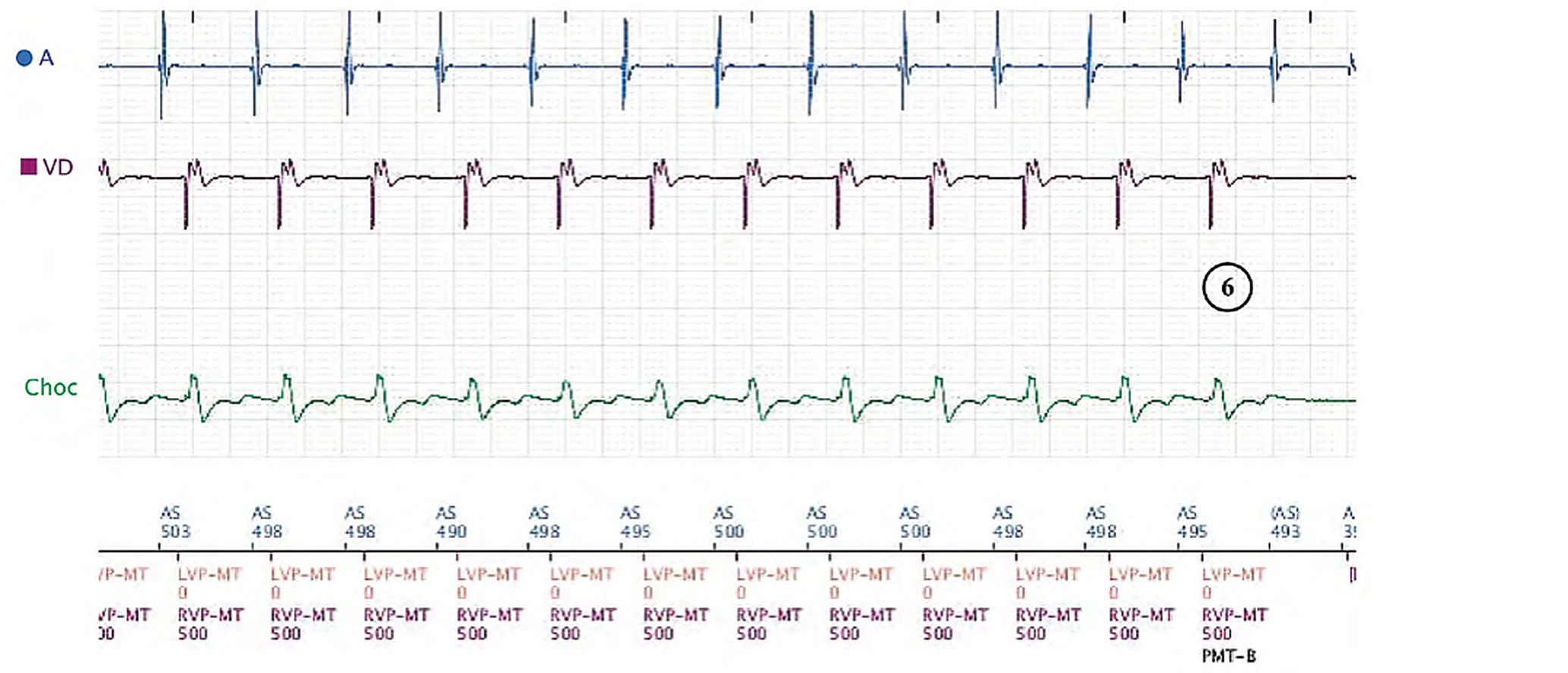 Électrogramme Boston Scientific CRT, segment 3/8 — Tachycardie sinusale, Wenckebach et effet pro-arythmogène