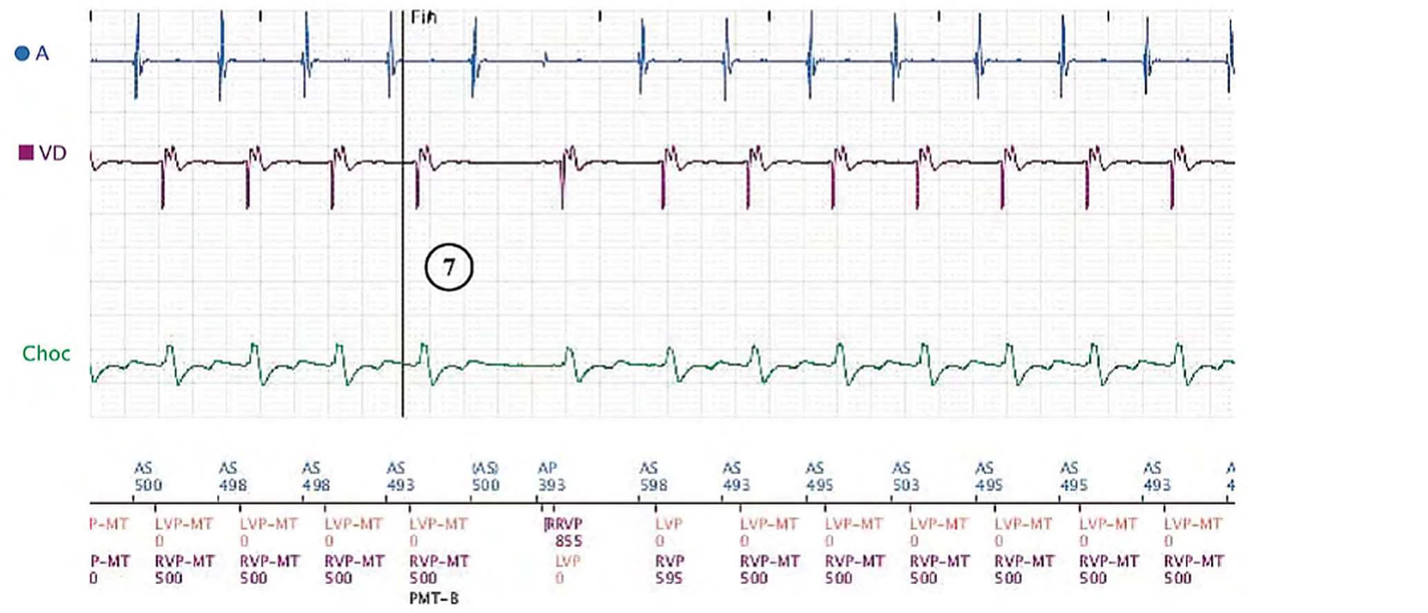 Électrogramme Boston Scientific CRT, segment 4/8 — Tachycardie sinusale, Wenckebach et effet pro-arythmogène