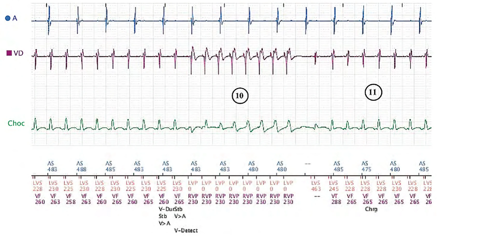 Électrogramme Boston Scientific CRT, segment 8/8 — Tachycardie sinusale, Wenckebach et effet pro-arythmogène