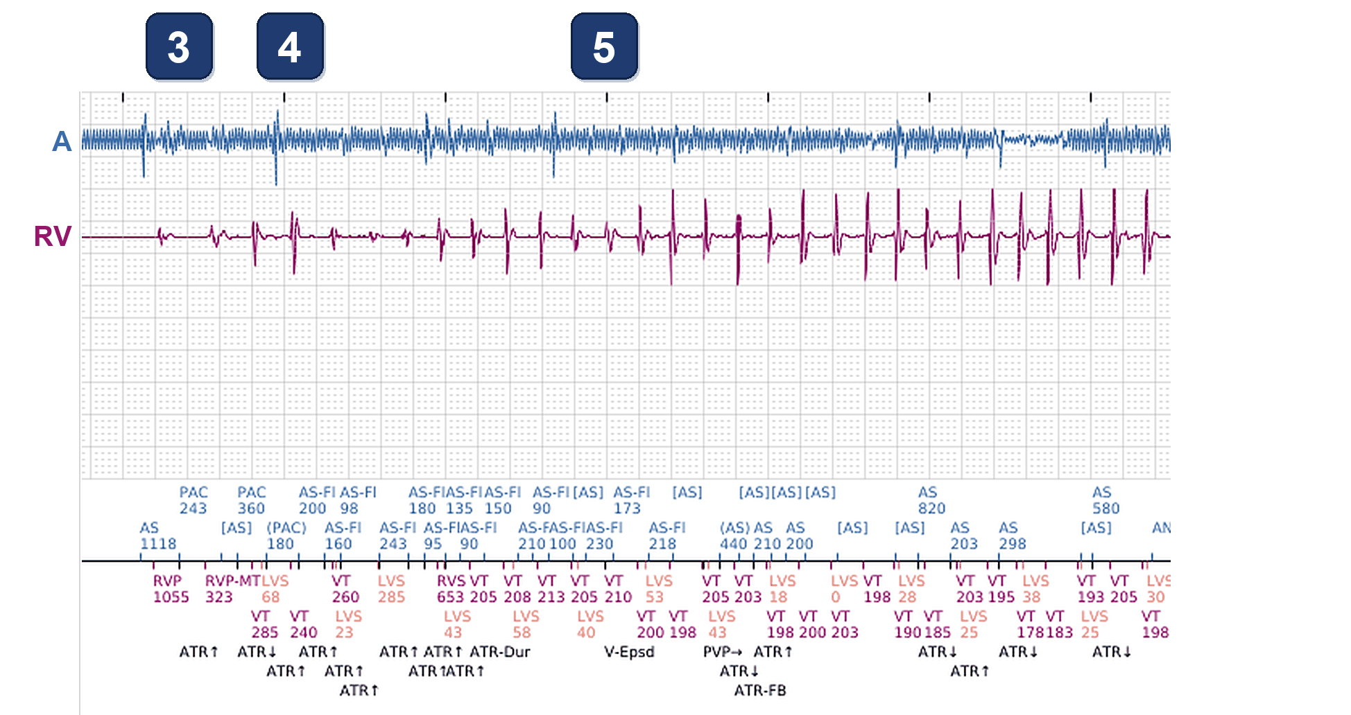 Électrogramme Boston Scientific CRT, segment 3/11 — Épisodes ventriculaires sur un CRT-P : qui les a déclenchés ?