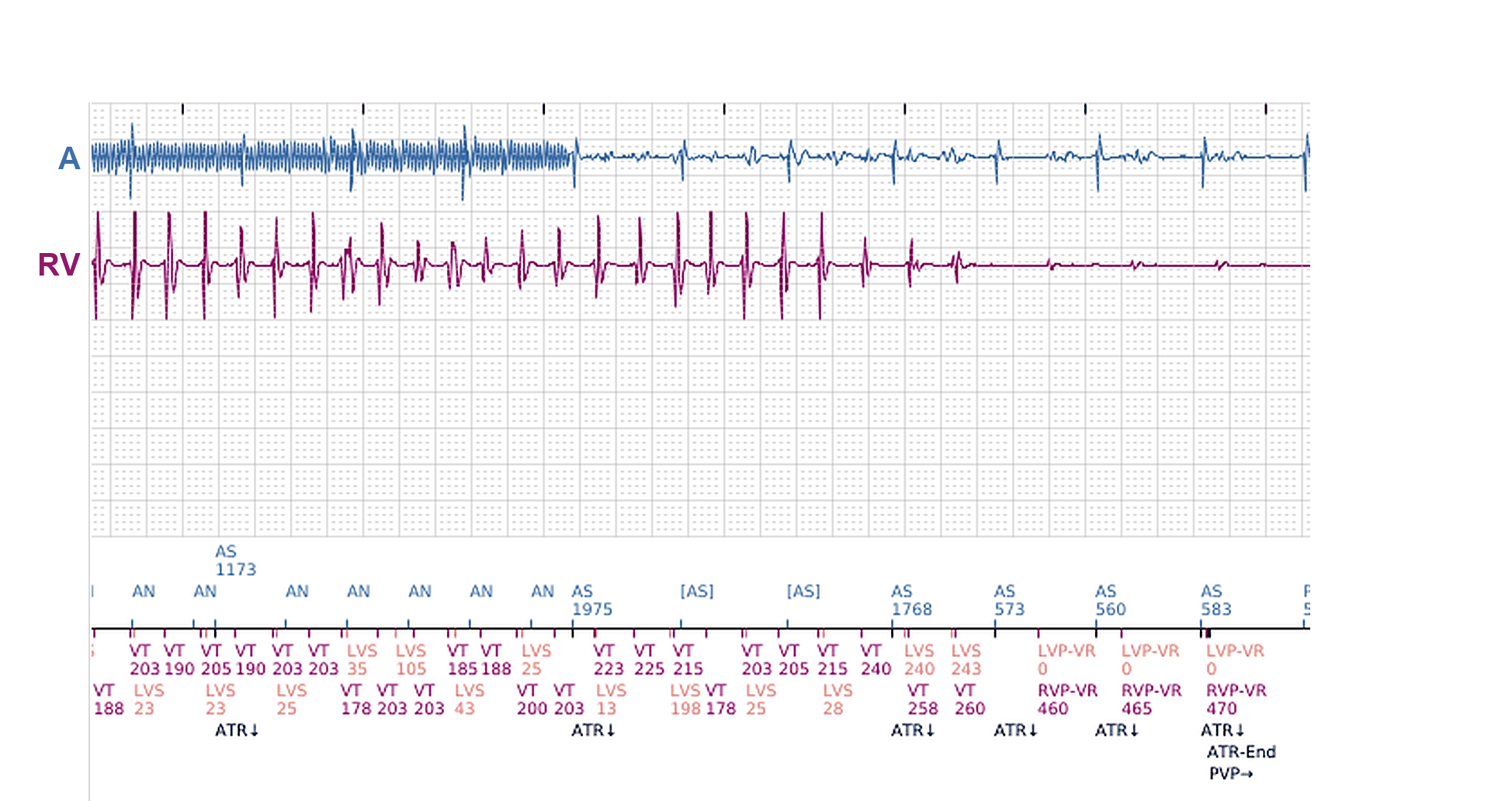 Électrogramme Boston Scientific CRT, segment 4/11 — Épisodes ventriculaires sur un CRT-P : qui les a déclenchés ?
