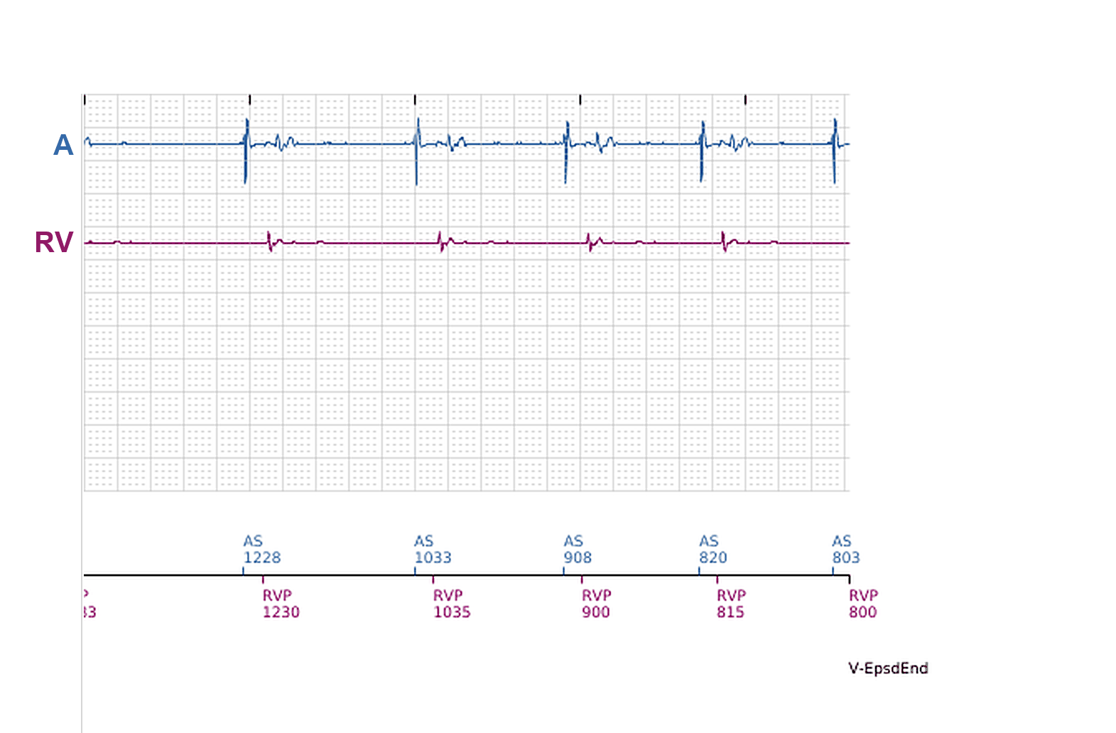 Électrogramme Boston Scientific CRT, segment 6/11 — Épisodes ventriculaires sur un CRT-P : qui les a déclenchés ?