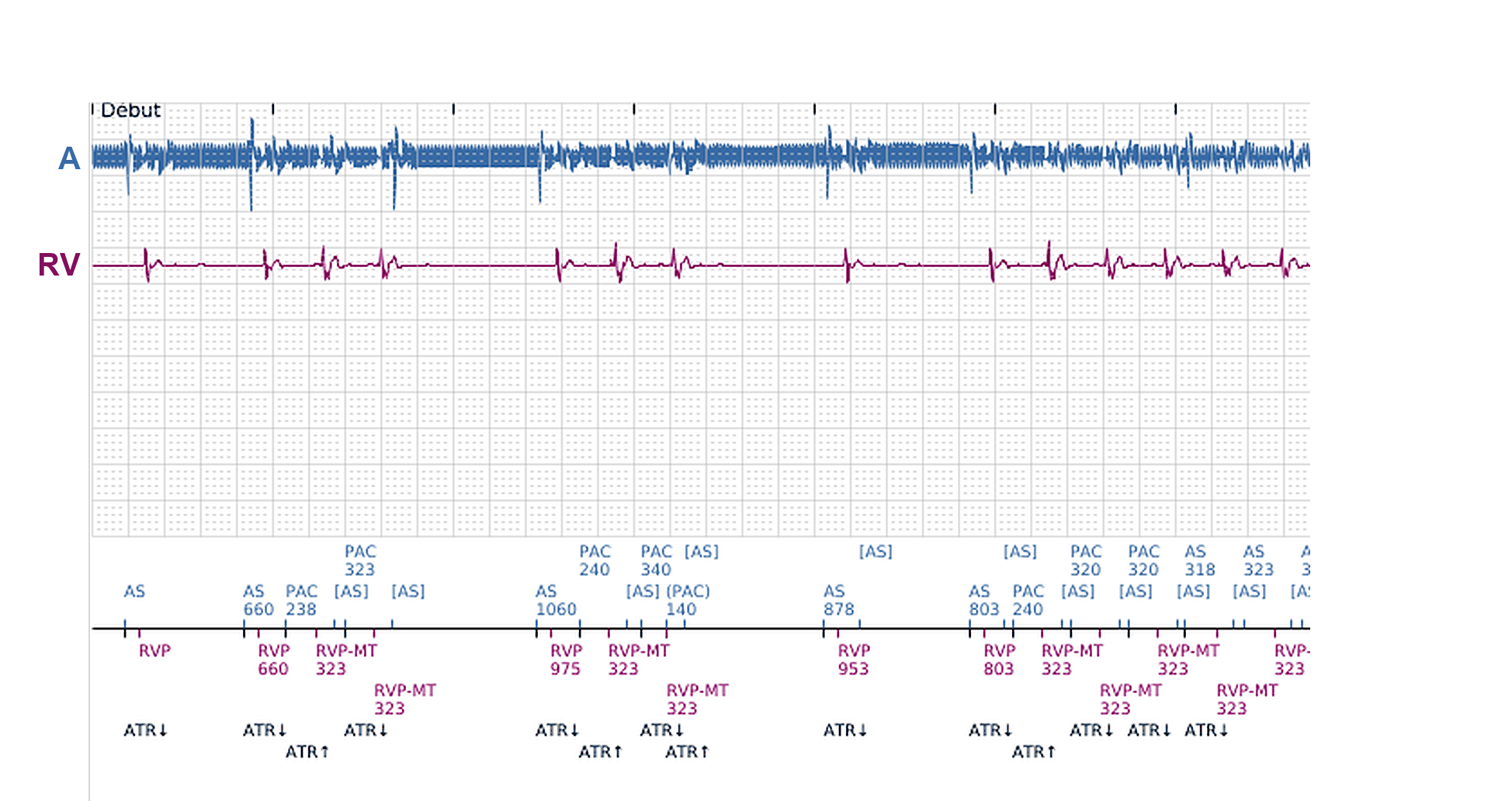 Électrogramme Boston Scientific CRT, segment 8/11 — Épisodes ventriculaires sur un CRT-P : qui les a déclenchés ?