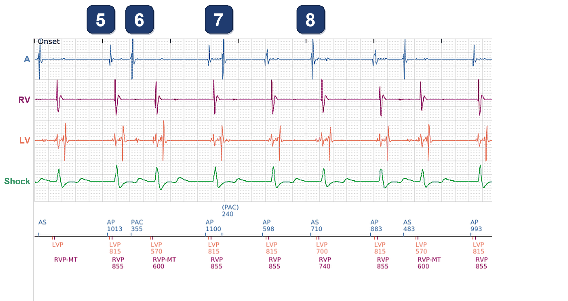 Électrogramme Boston Scientific CRT, segment 3/3 — Alerte d'impédance de sonde OD chez un patient stimulé