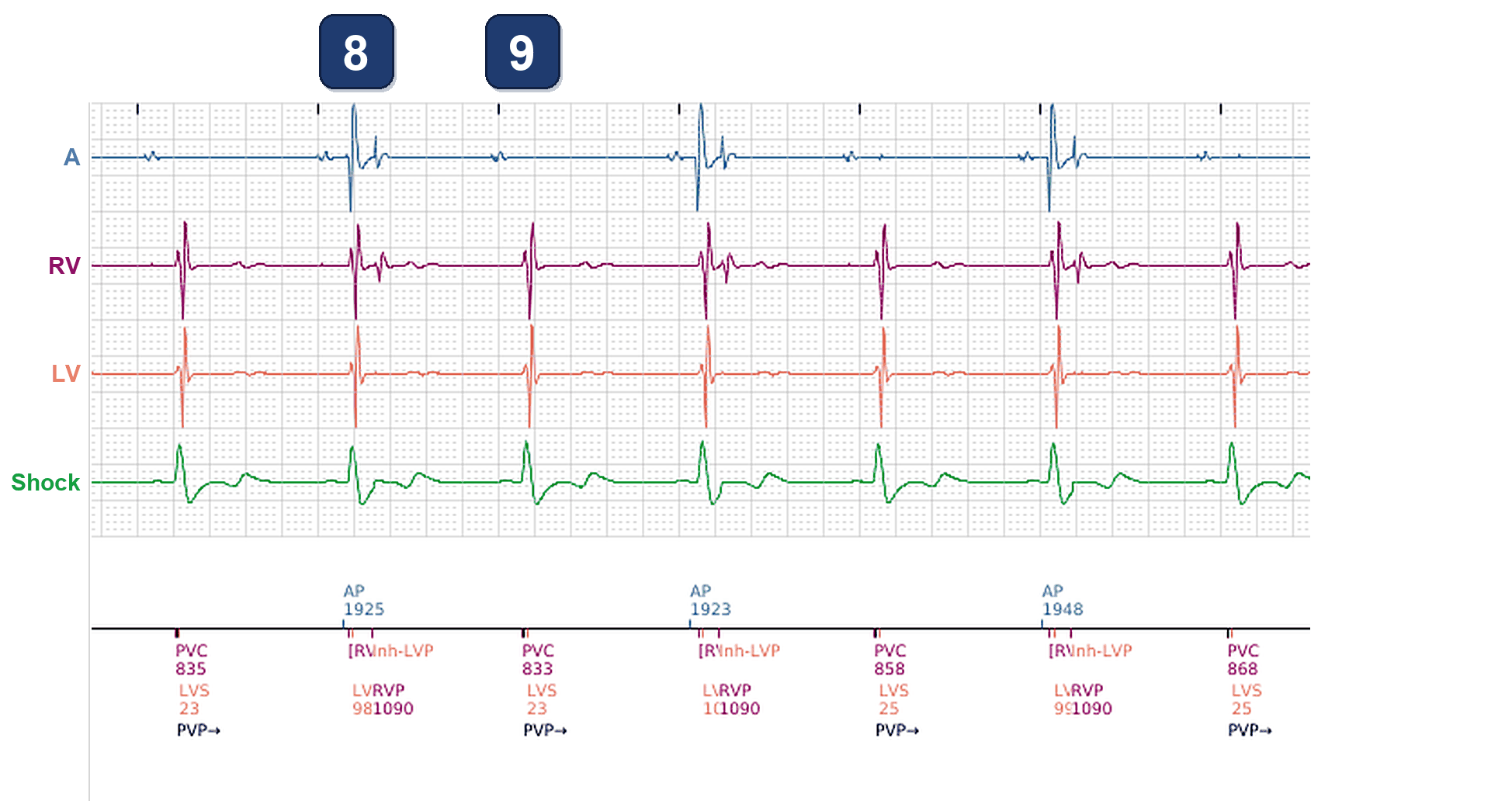 Électrogramme Boston Scientific CRT, segment 4/4 — Chute de la CRT et événements atriaux de faible amplitude