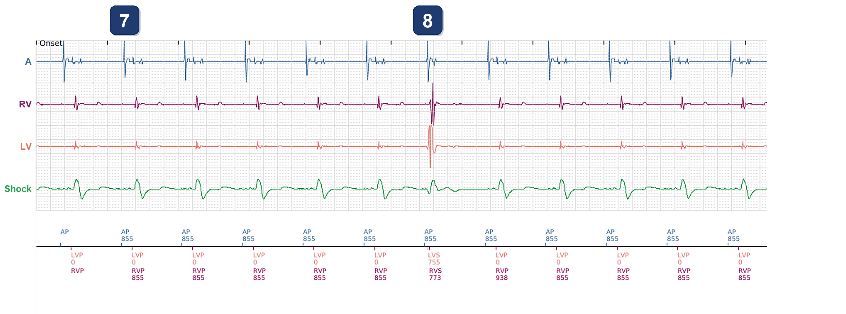 Électrogramme Boston Scientific CRT, segment 4/4 — Perte de resynchronisation au repos sur bradycardie sinusale