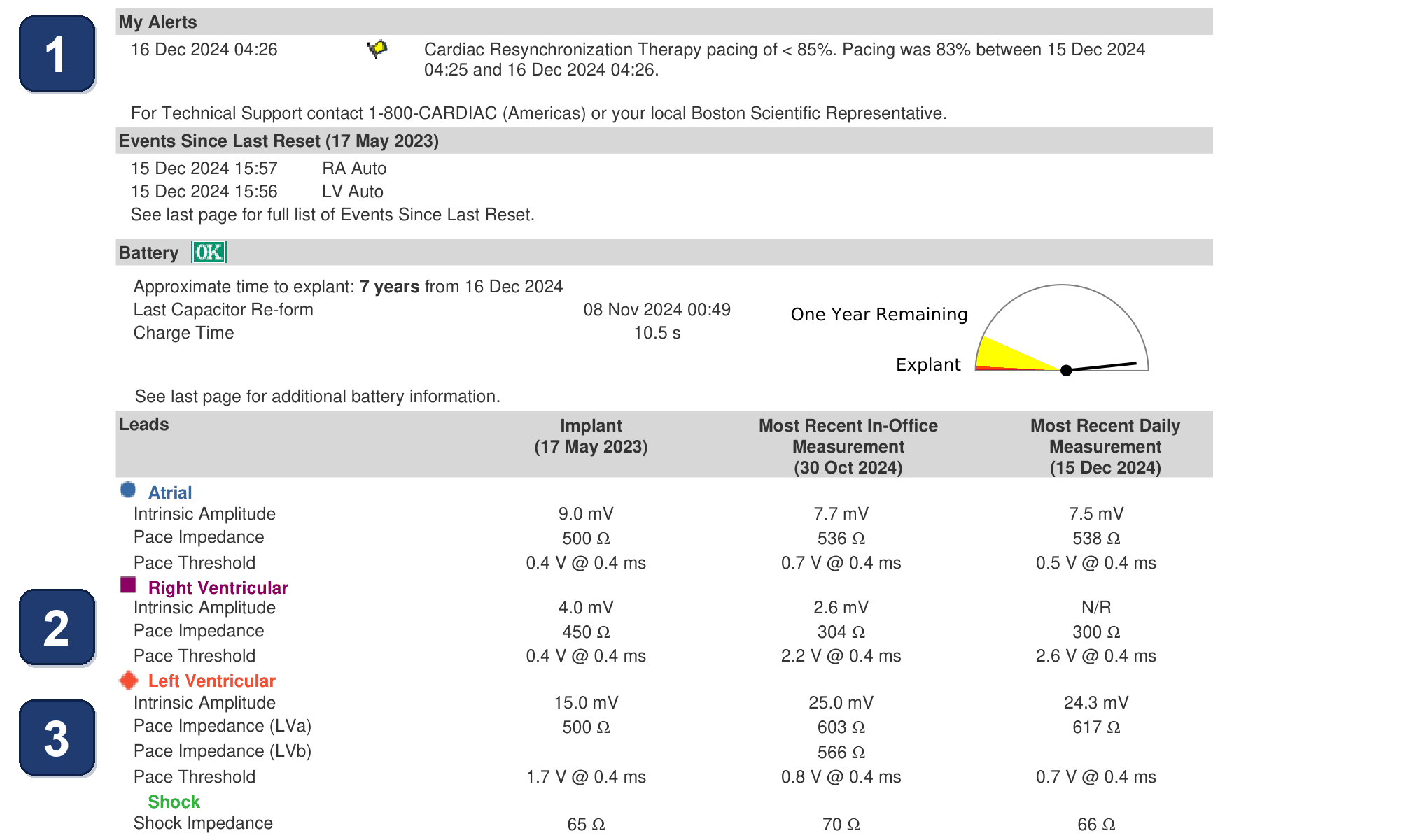 Électrogramme Boston Scientific CRT, segment 1/3 — VD stimulé à 100 %, VG à 86 % seulement