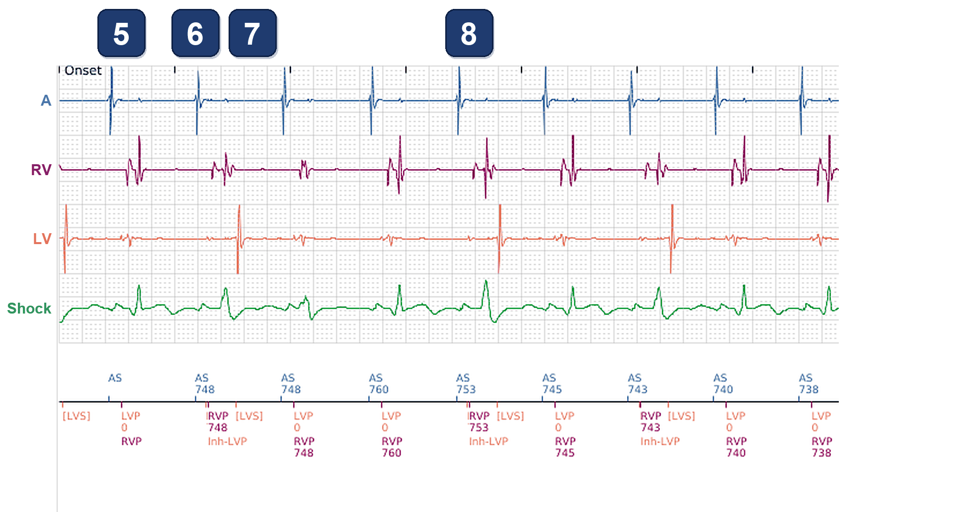 Électrogramme Boston Scientific CRT, segment 3/3 — VD stimulé à 100 %, VG à 86 % seulement