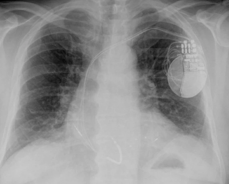 Radiographie thoracique une semaine après la transmission (face) : la CRT-D en région pectorale gauche ; les sondes VD et VG se sont toutes deux déplacées dans l’oreillette droite
