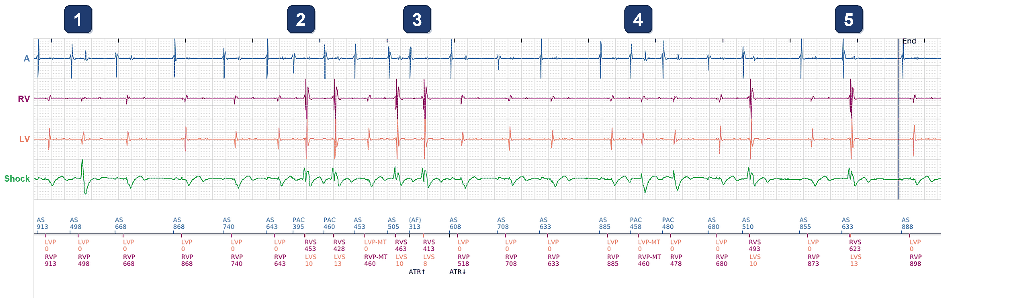 Électrogramme Boston Scientific CRT, segment 1/4 — Chute de la CRT chez un patient avec ectopie atriale
