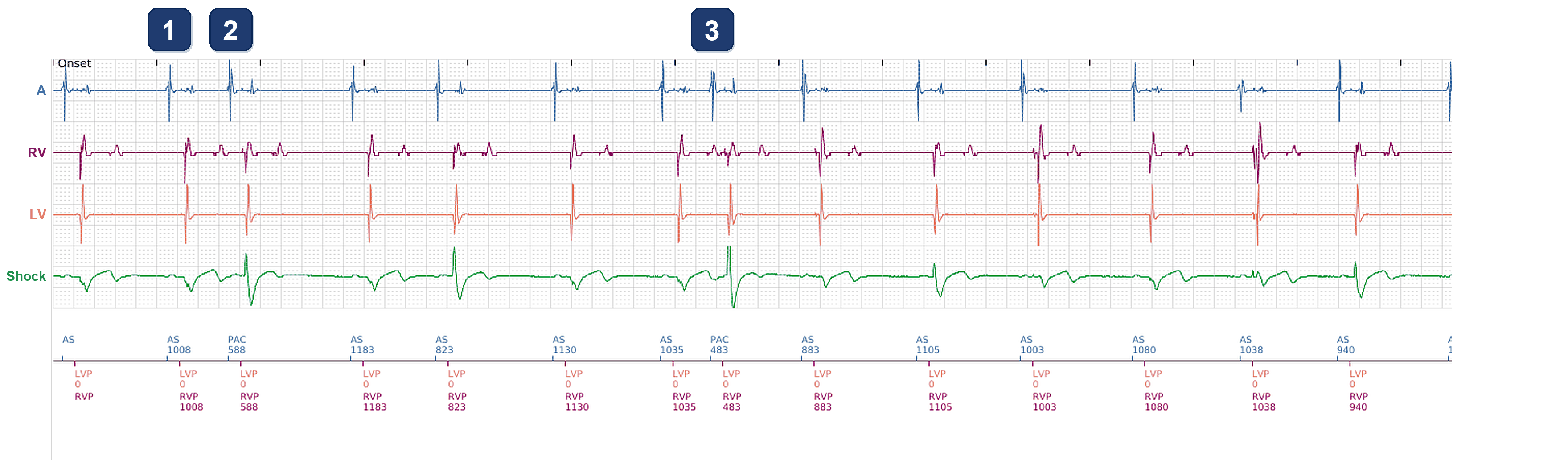 Électrogramme Boston Scientific CRT, segment 3/4 — Chute de la CRT chez un patient avec ectopie atriale