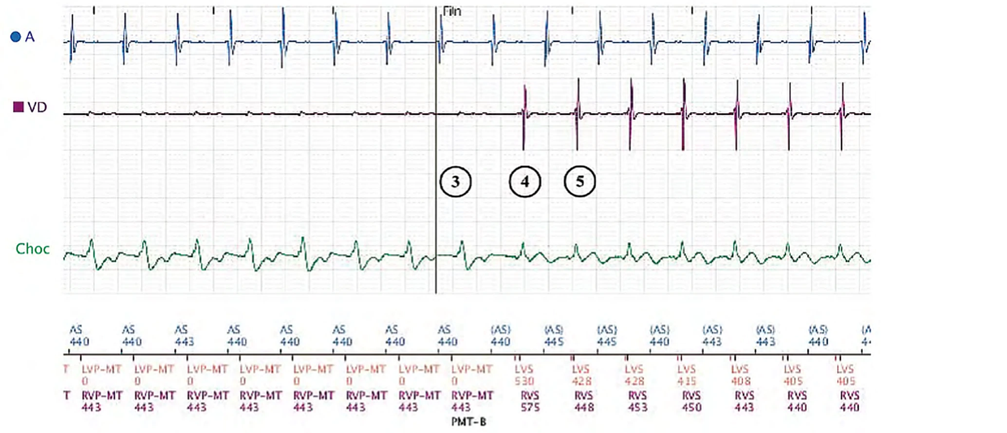 Électrogramme Boston Scientific CRT, segment 2/3 — Effort, algorithme anti-TRE et PR long