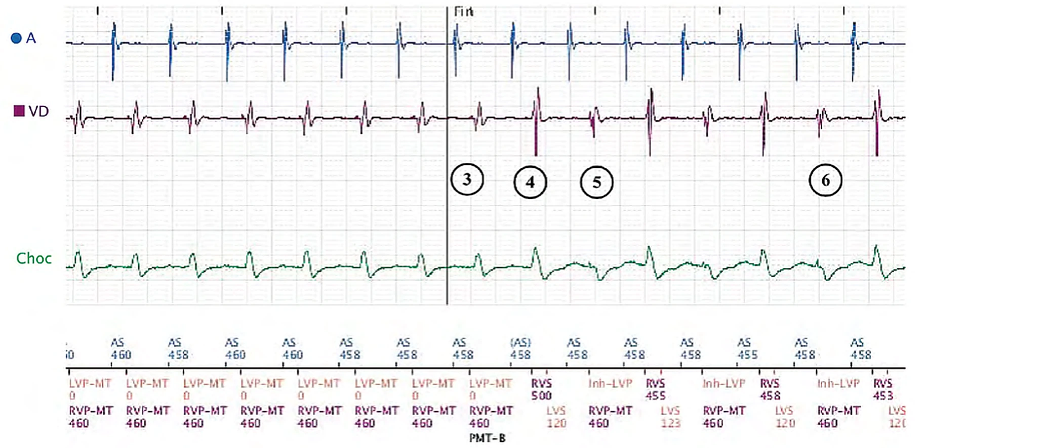 Électrogramme Boston Scientific CRT, segment 2/3 — Effort, algorithme anti-TRE et détection VG