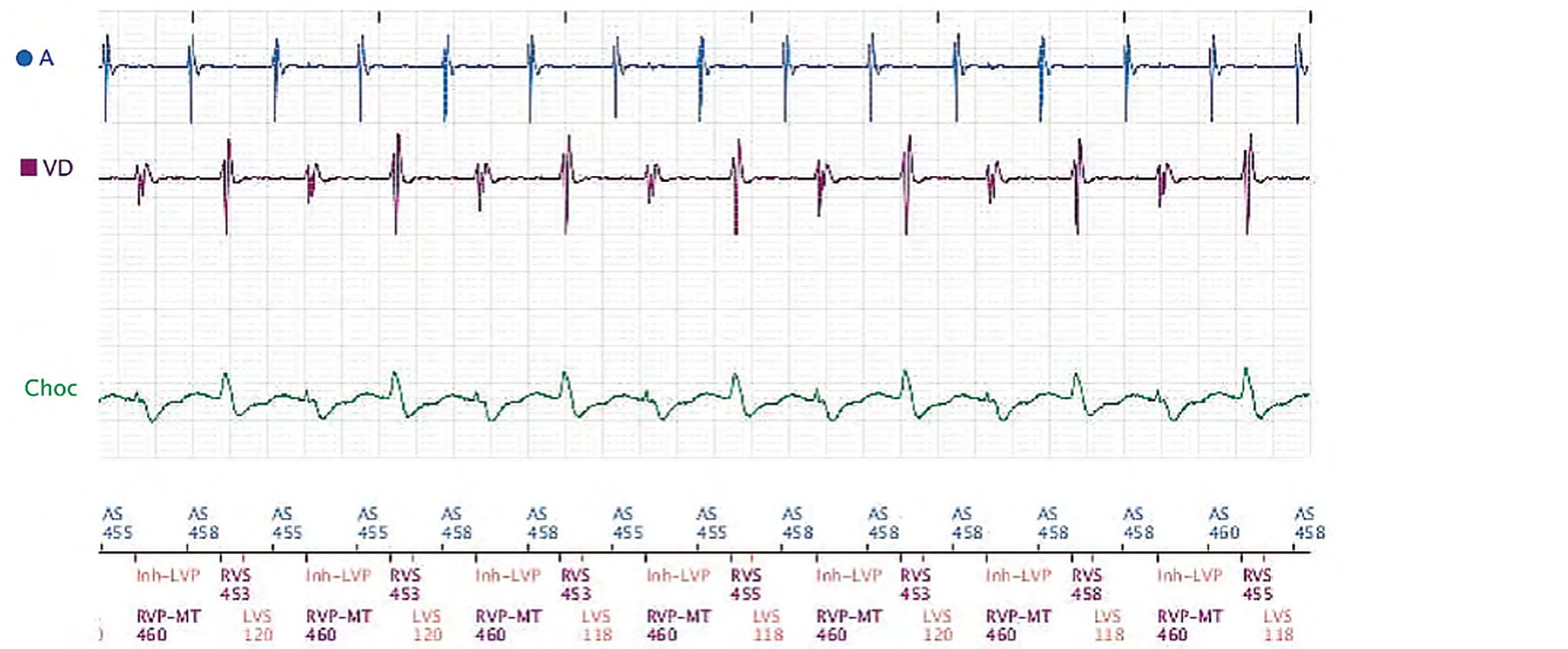 Électrogramme Boston Scientific CRT, segment 3/3 — Effort, algorithme anti-TRE et détection VG