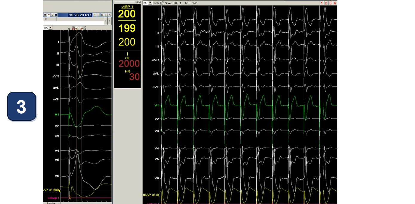 Électrogramme Boston Scientific CRT, segment 3/13 — CRT avec un stimulateur double chambre par LBBAP