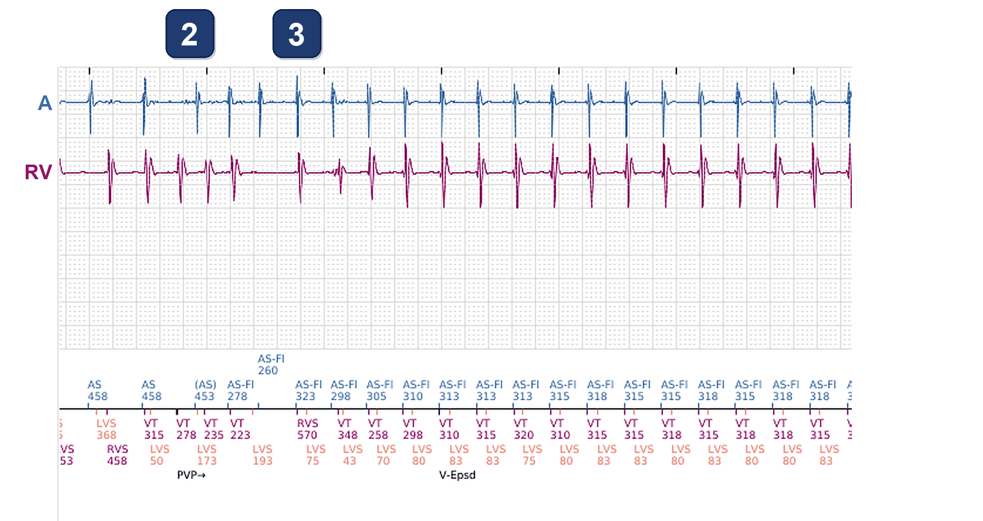Électrogramme Boston Scientific CRT, segment 2/12 — Tachycardie en dansant : ce qu'ont vu le CRT-P et le DAI sous-cutané