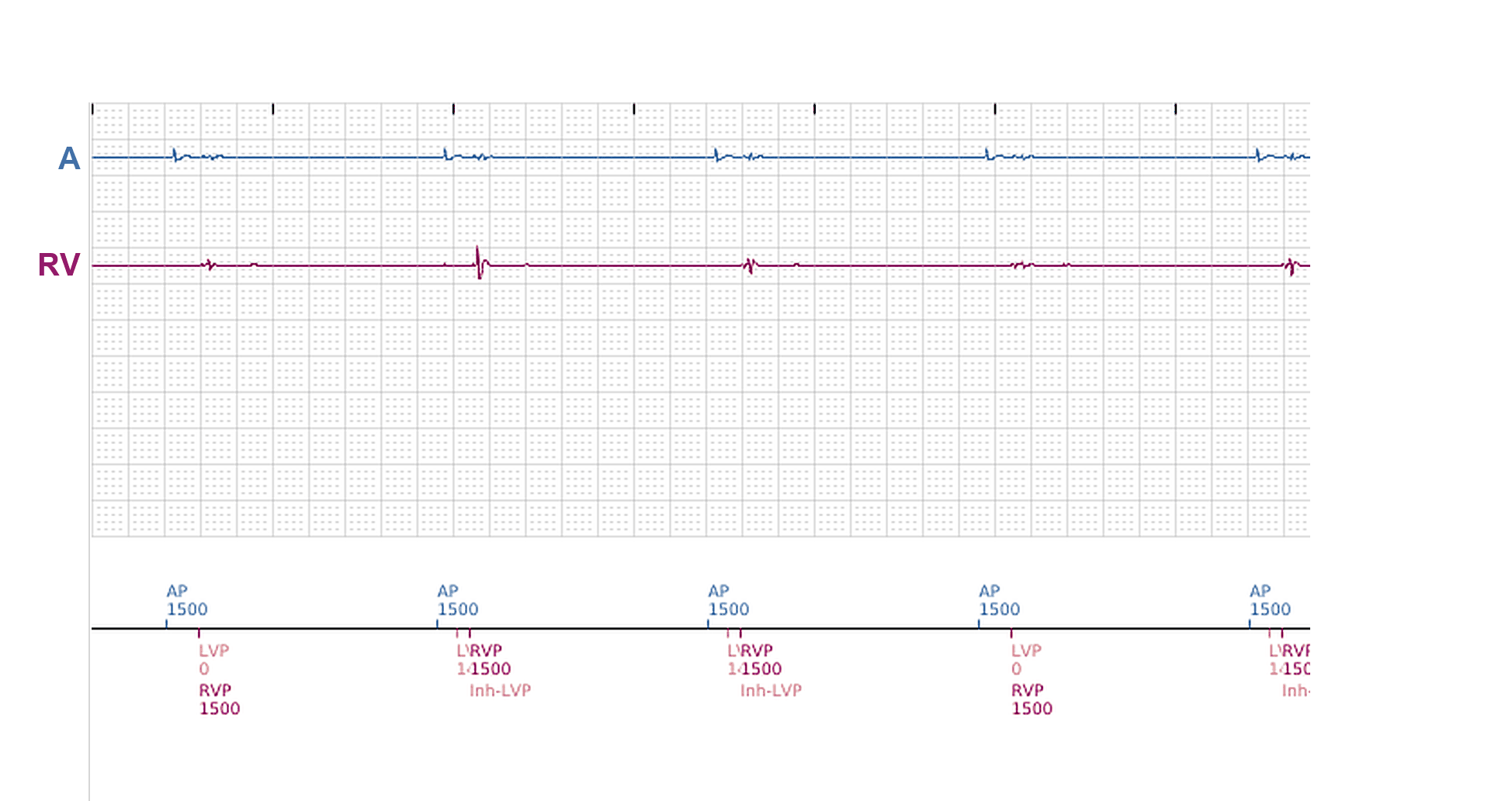 Électrogramme Boston Scientific CRT, segment 5/12 — Tachycardie en dansant : ce qu'ont vu le CRT-P et le DAI sous-cutané