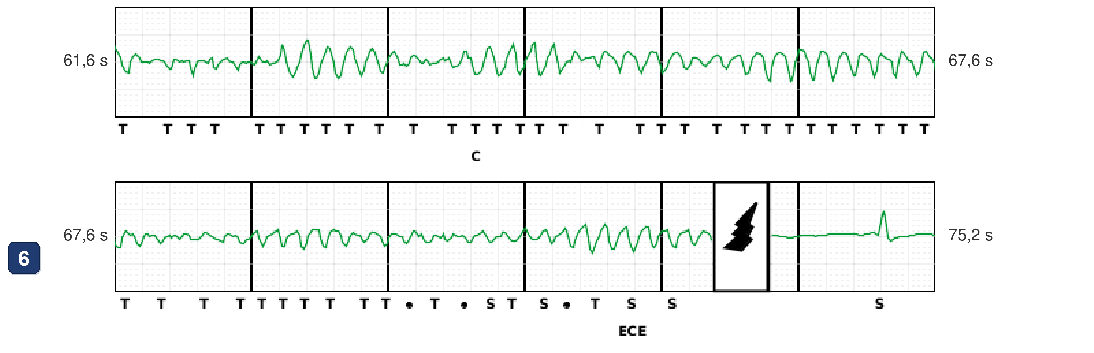 Électrogramme Boston Scientific CRT, segment 11/12 — Tachycardie en dansant : ce qu'ont vu le CRT-P et le DAI sous-cutané