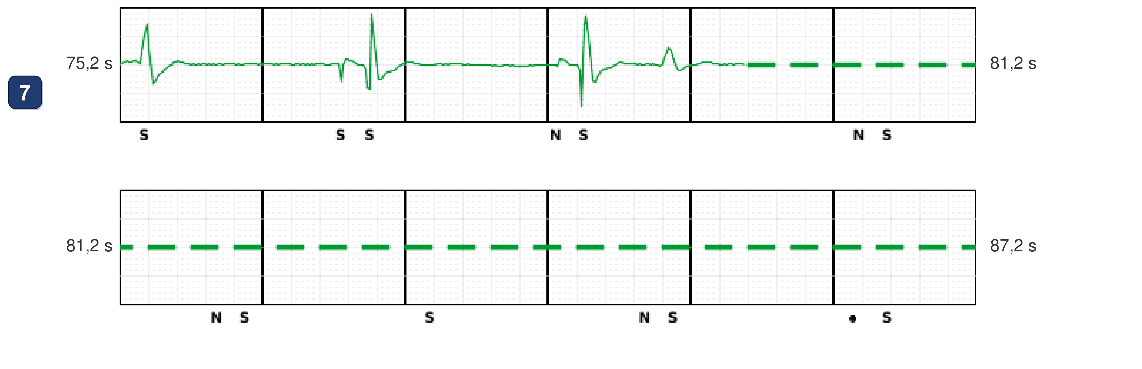 Électrogramme Boston Scientific CRT, segment 12/12 — Tachycardie en dansant : ce qu'ont vu le CRT-P et le DAI sous-cutané