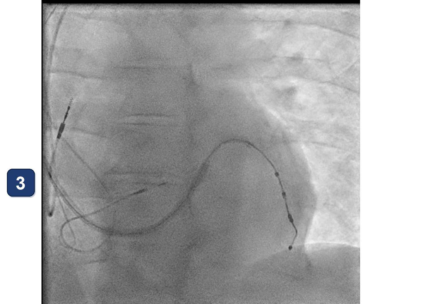 Électrogramme Boston Scientific CRT, segment 4/10 — LOT-CRT avec un CRT-P Boston