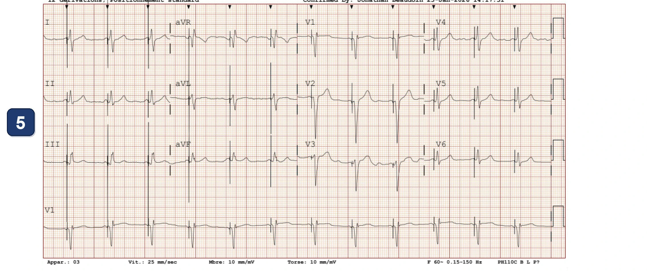 Électrogramme Boston Scientific CRT, segment 7/10 — LOT-CRT avec un CRT-P Boston