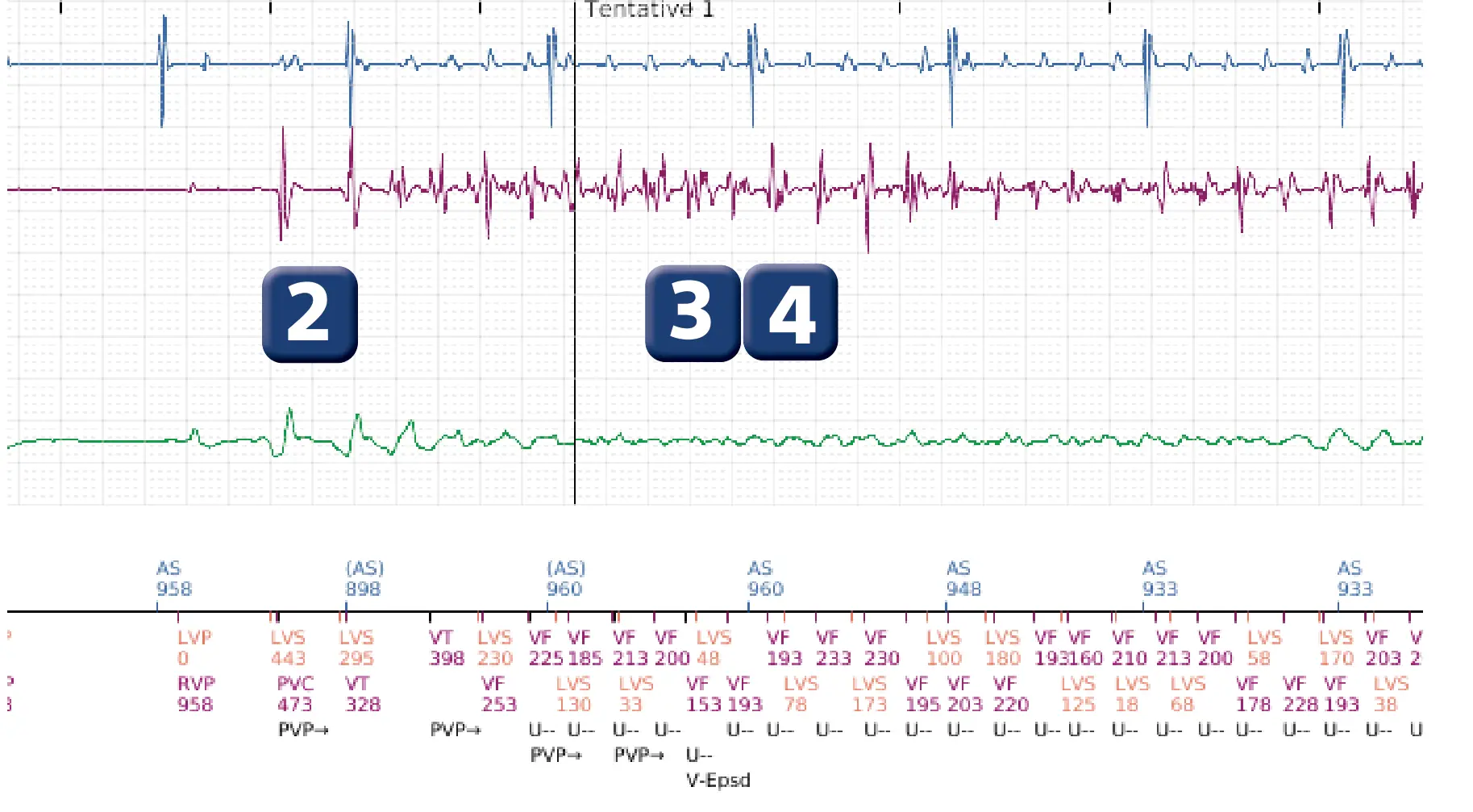 Électrogramme Boston Scientific DAI, segment 2 sur 6 — Détection et traitement d’un épisode de FV