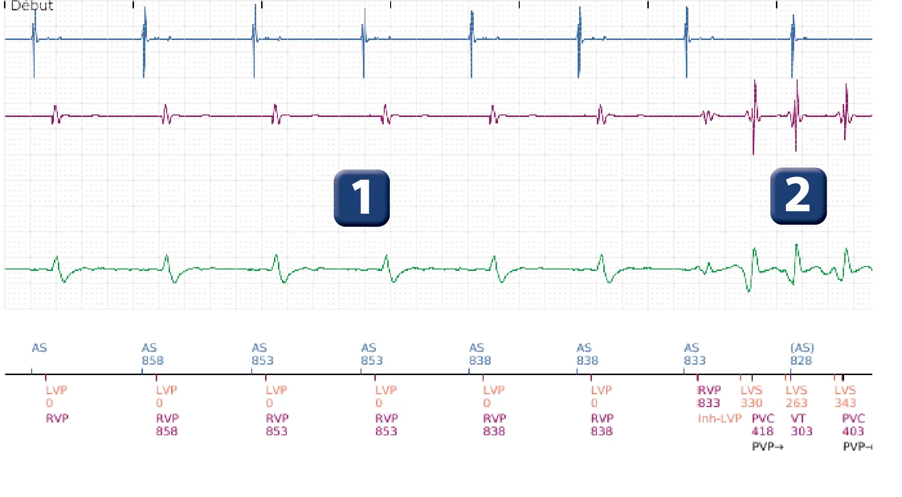 Électrogramme Boston Scientific DAI, segment 1 sur 4 — Tachycardie ventriculaire non soutenue
