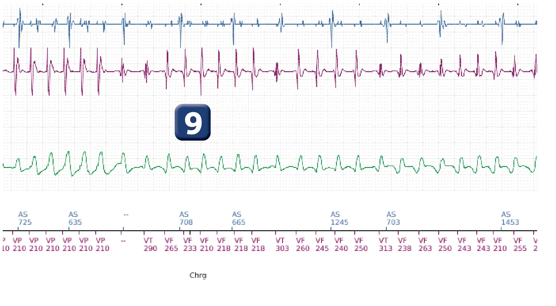 Électrogramme Boston Scientific DAI, segment 3 sur 5 — Réduction spontanée et déviation de la charge