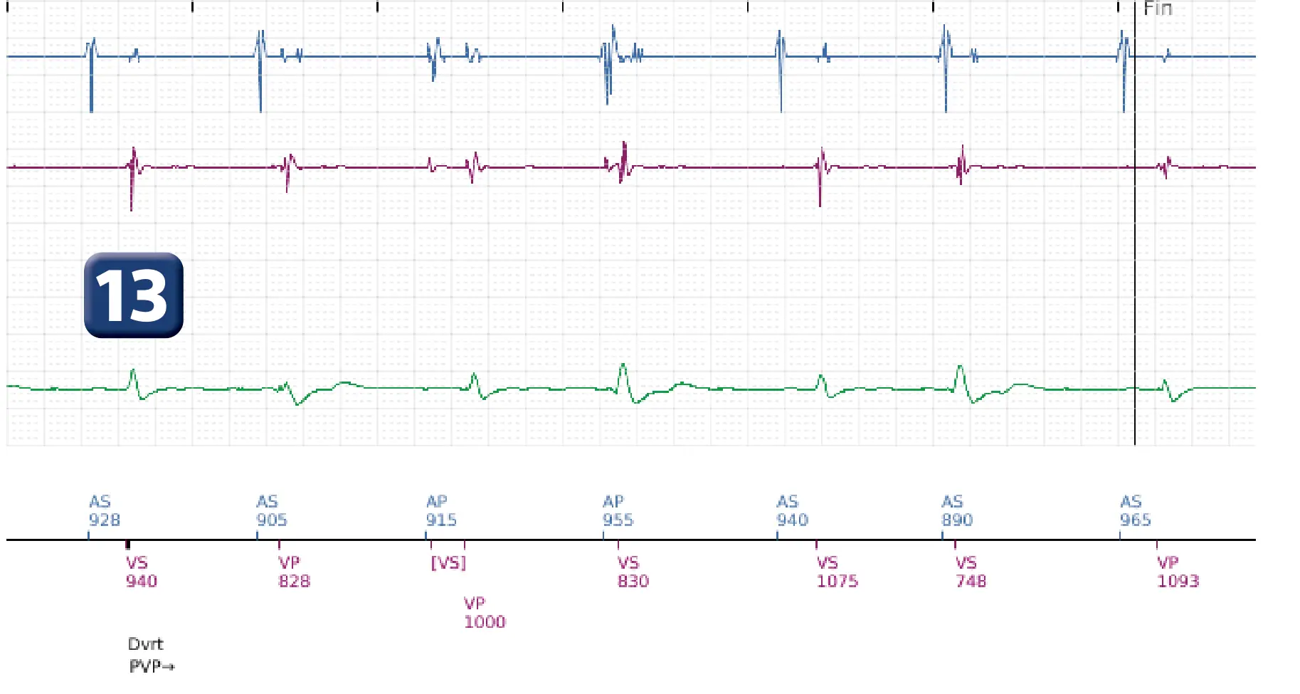 Électrogramme Boston Scientific DAI, segment 5 sur 5 — Réduction spontanée et déviation de la charge