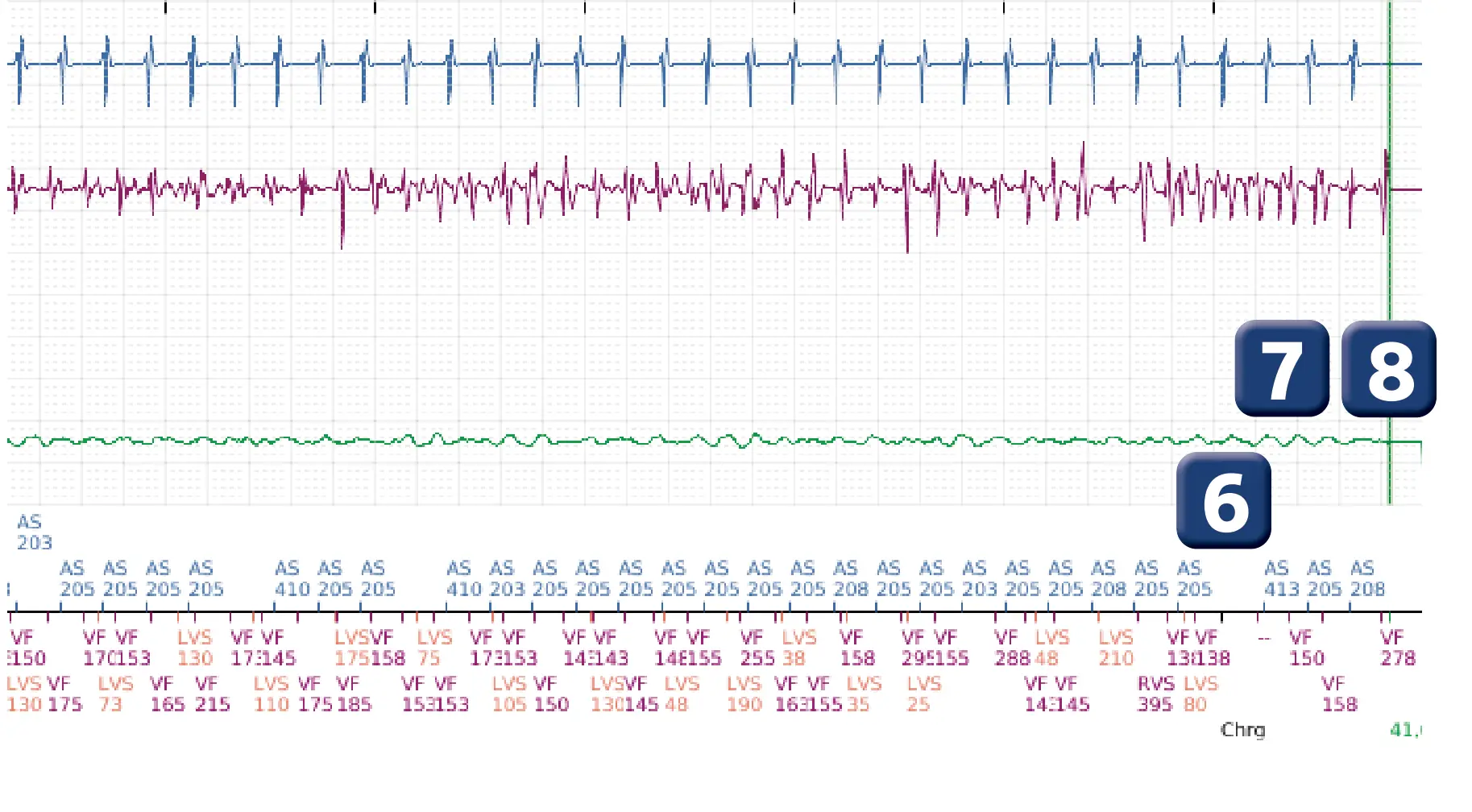 Électrogramme Boston Scientific DAI, segment 3 sur 4 — Fenêtre de déviation en fin de charge