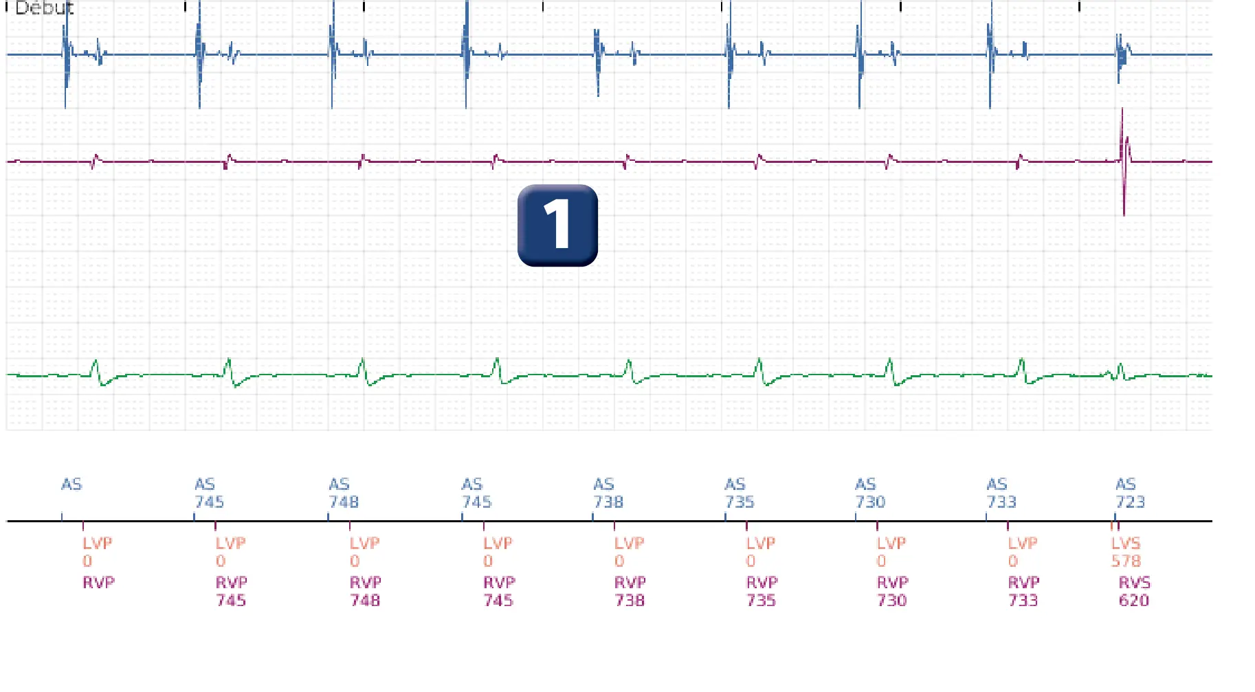 Électrogramme Boston Scientific DAI, segment 1 sur 5 — Episode de FV correctement détecté et traité par un choc d’énergie maximale