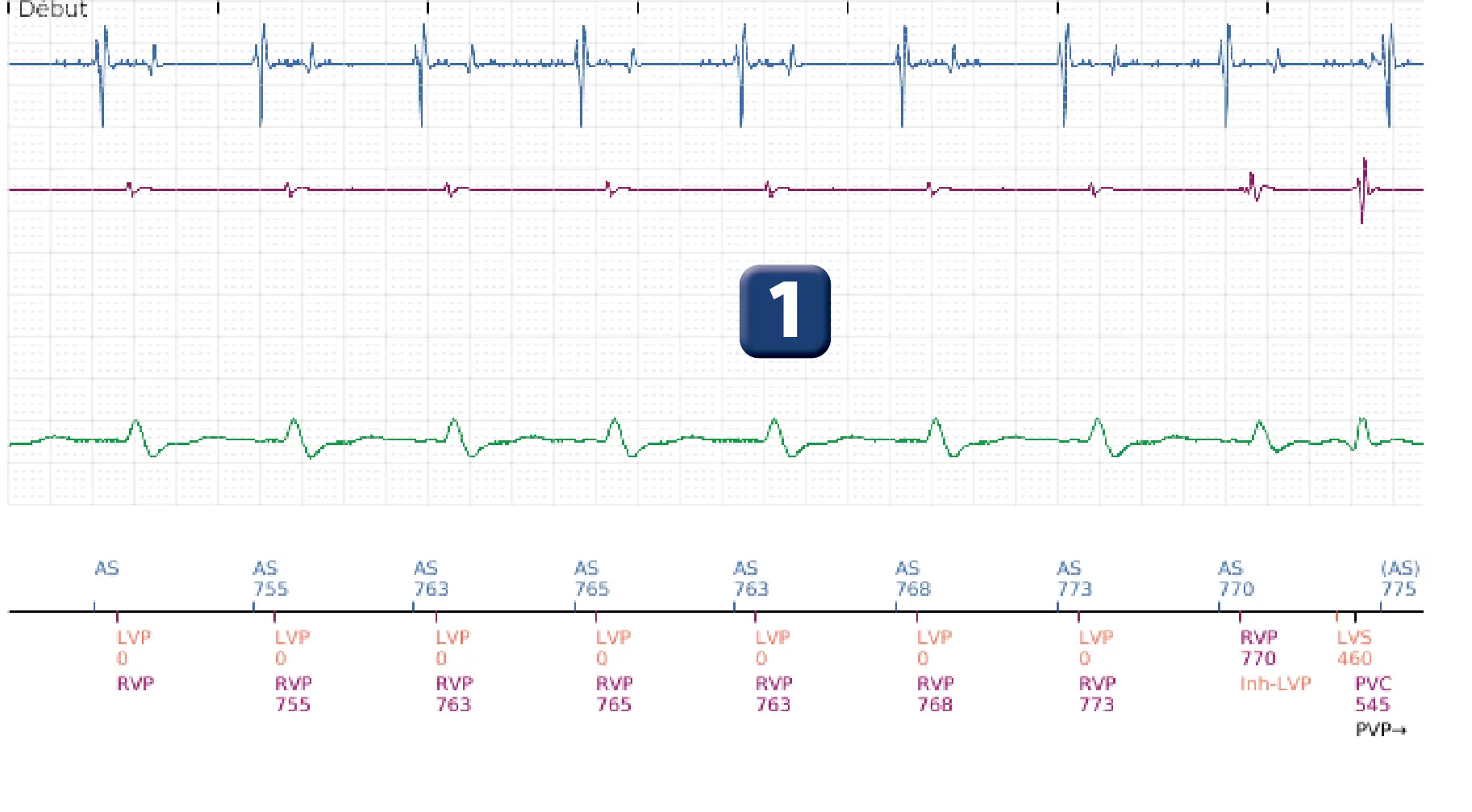 Électrogramme Boston Scientific DAI, segment 1 sur 5 — Stimulation anti-tachycardique en zone de TV