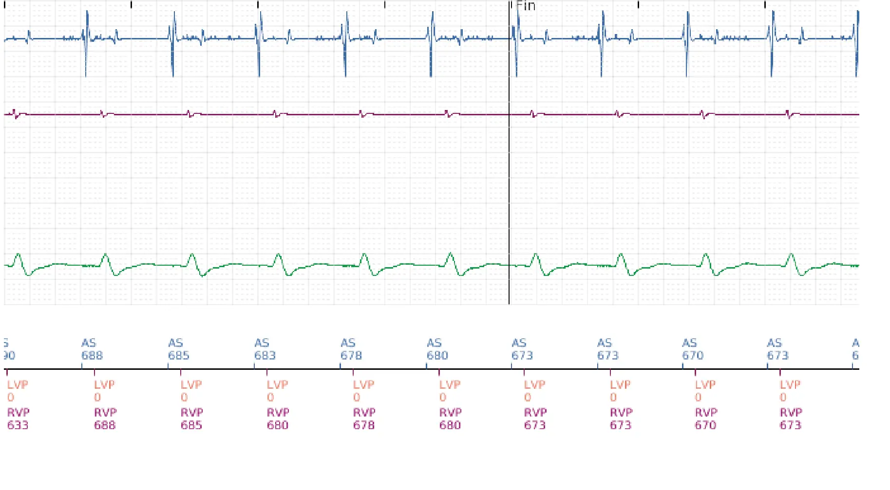 Électrogramme Boston Scientific DAI, segment 5 sur 5 — Stimulation anti-tachycardique en zone de TV