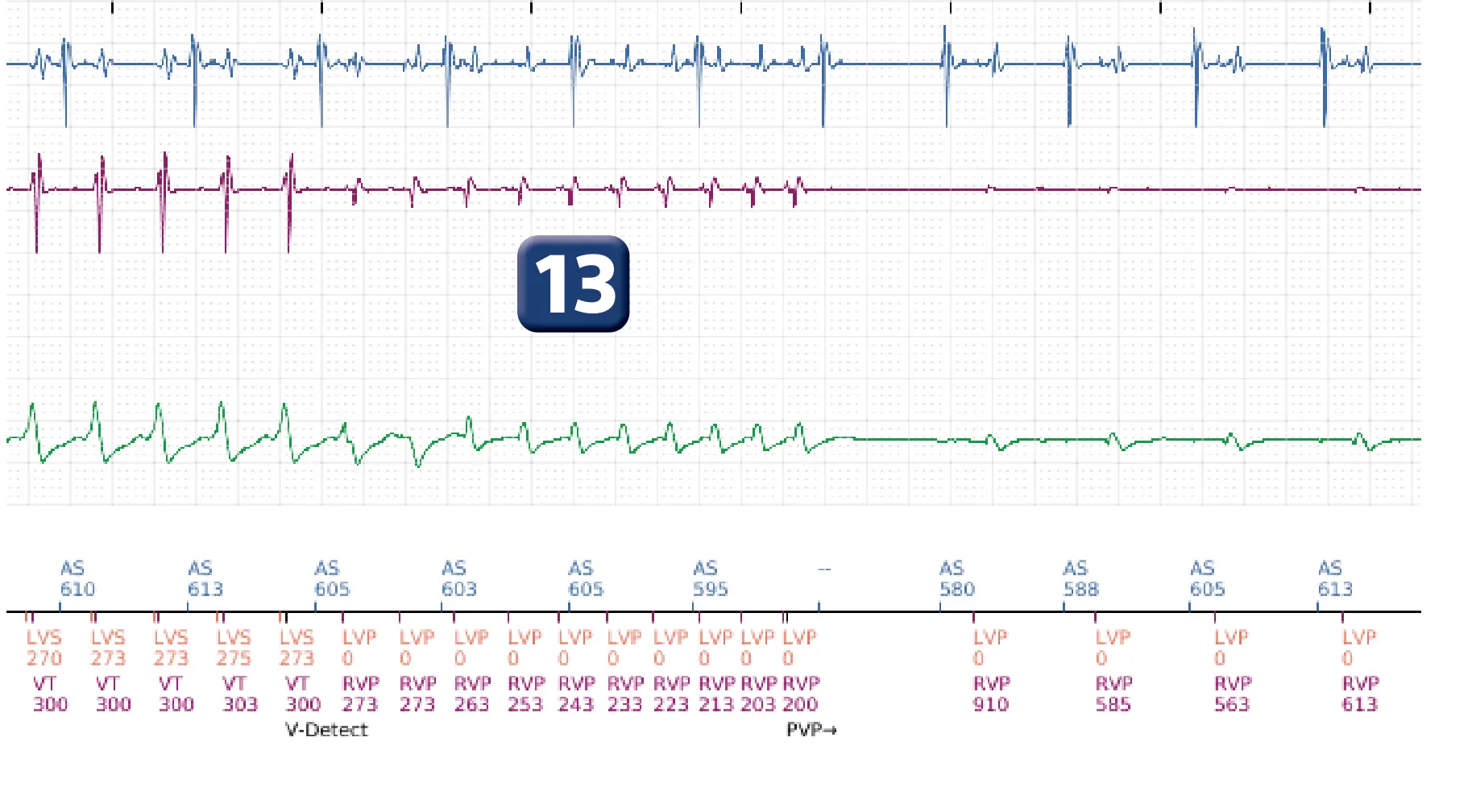 Électrogramme Boston Scientific DAI, segment 11 sur 16 — Stimulation anti-tachycardique en zone de TV et durée post-redétection