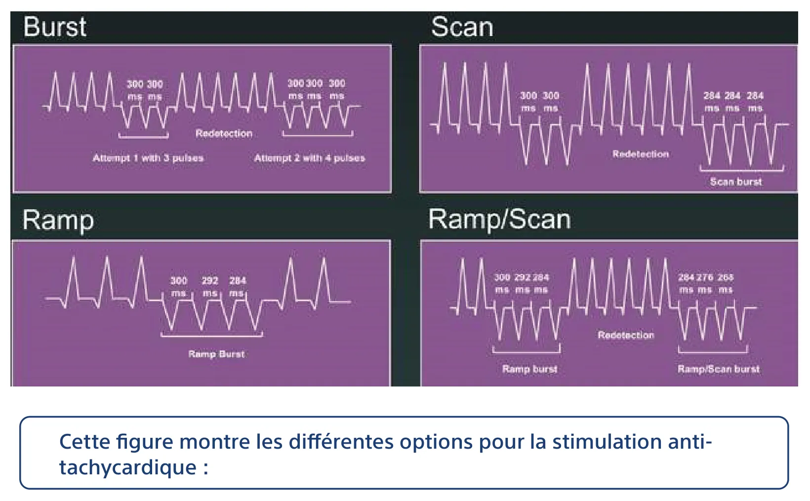 Cette figure montre les différentes options pour la stimulation anti-tachycardique :