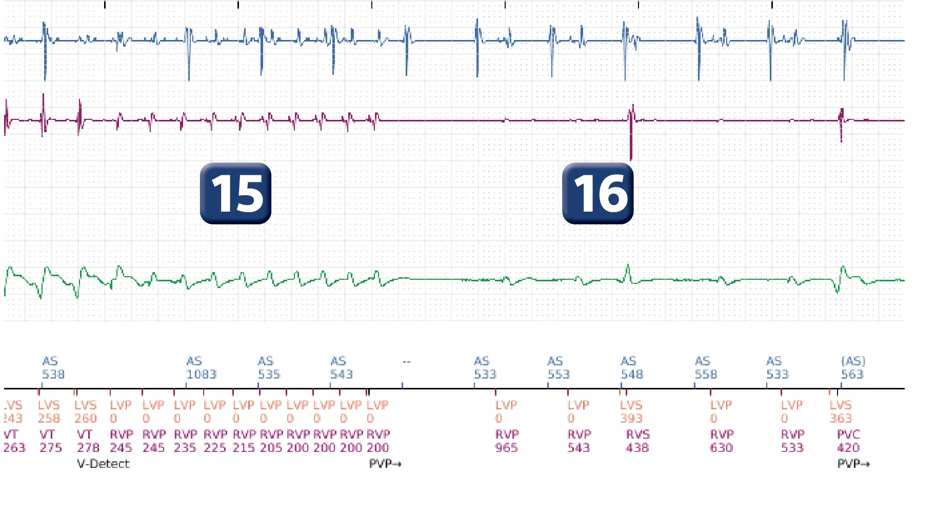 Électrogramme Boston Scientific DAI, segment 12 sur 16 — Progression des thérapies en zone de TV