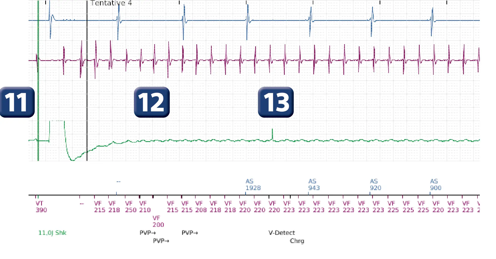 Électrogramme Boston Scientific DAI, segment 14 sur 16 — Choc à faible amplitude et accélération de l’arythmie