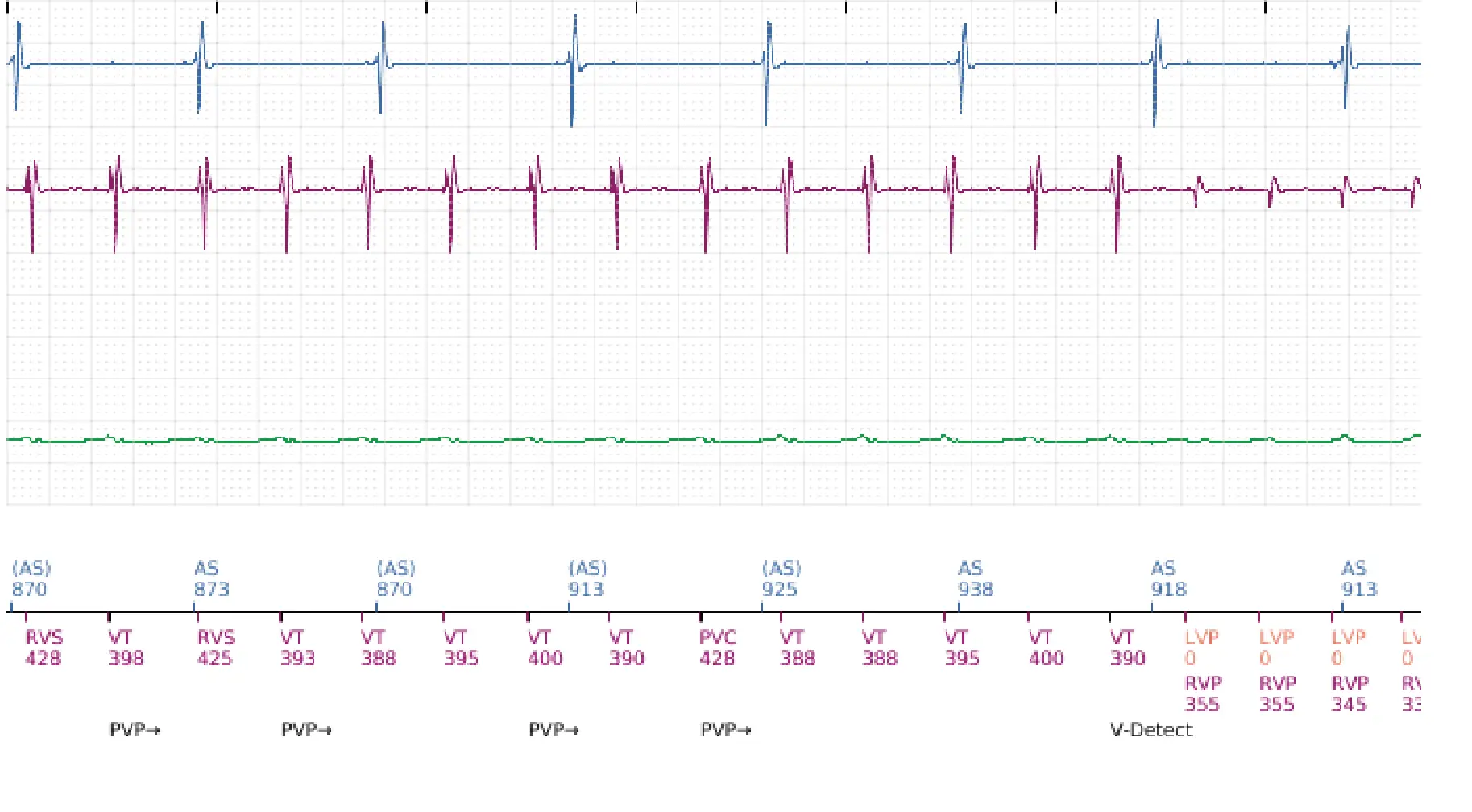 Électrogramme Boston Scientific DAI, segment 9 sur 16 — Choc à faible amplitude et accélération de l’arythmie