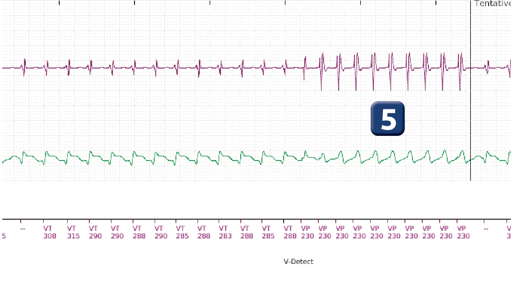 Électrogramme Boston Scientific DAI, segment 4 sur 10 — Choc maximal en zone de TV
