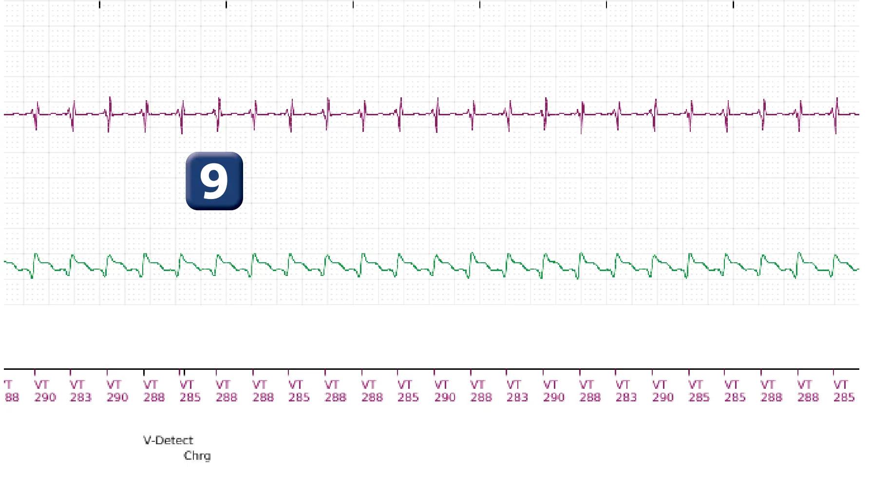 Électrogramme Boston Scientific DAI, segment 8 sur 10 — Choc maximal en zone de TV