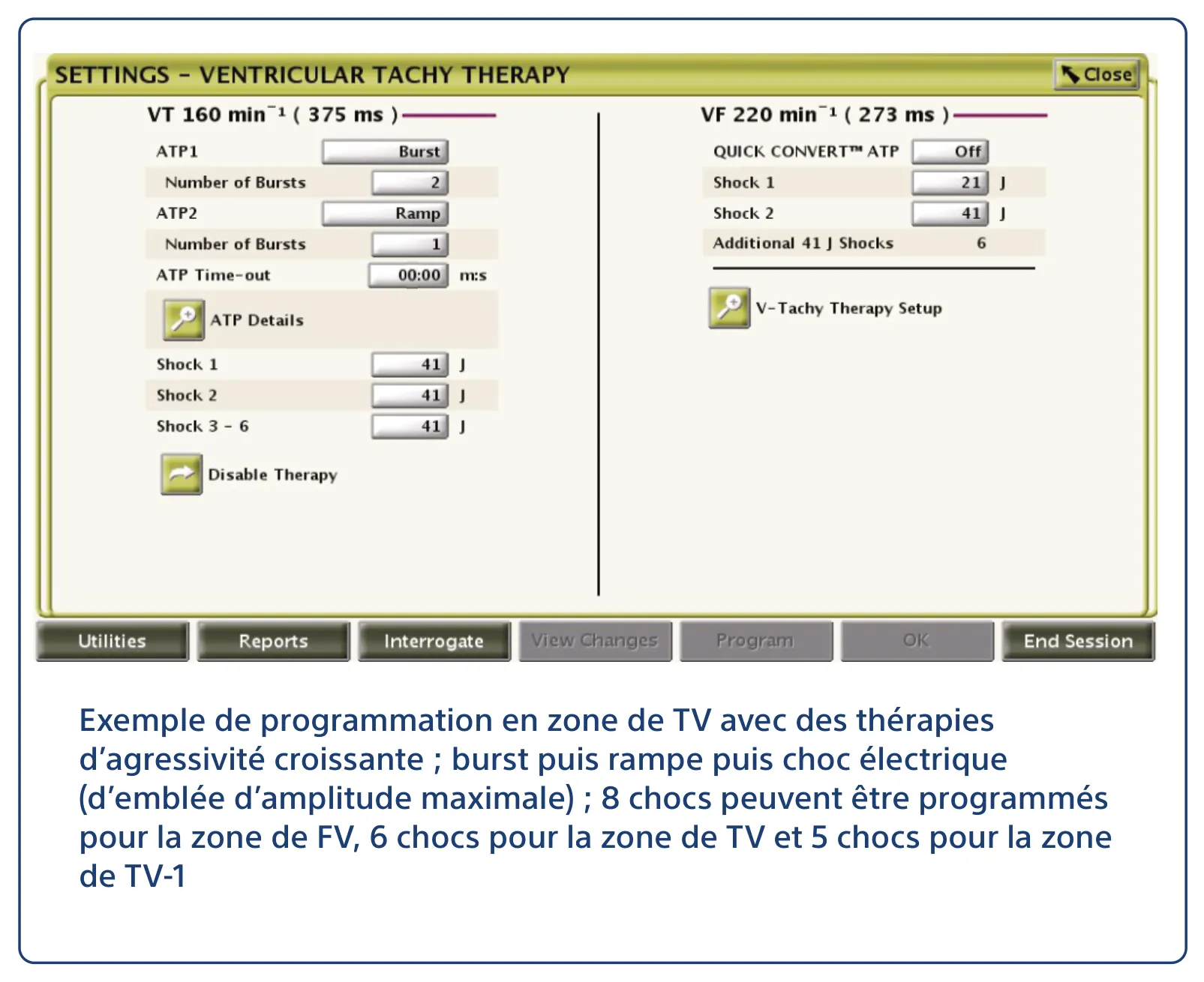 Exemple de programmation en zone de TV avec des thérapies d’agressivité croissante ; burst puis rampe puis choc électrique (d’emblée d’amplitude maximale) ; 8 chocs peuvent être programmés pour la zone de FV, 6 chocs pour la zone de TV et 5 chocs pour la zone de TV-1