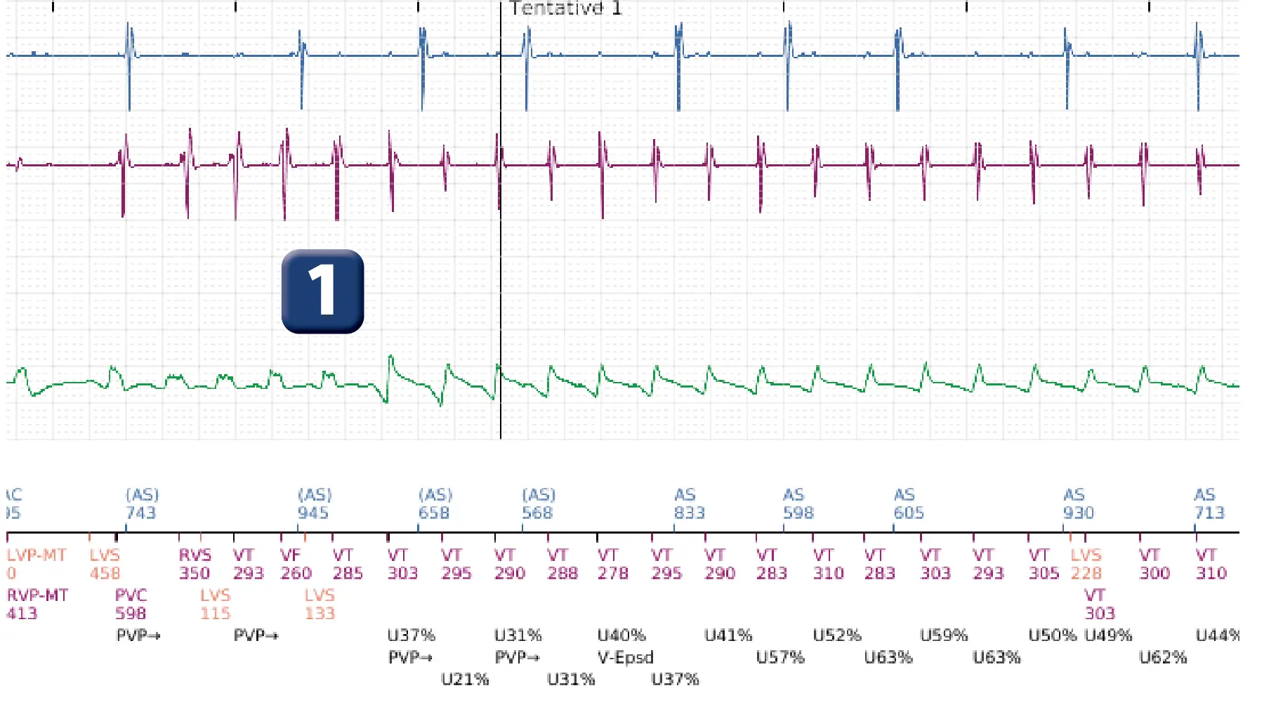Électrogramme Boston Scientific DAI, segment 2 sur 6 — Stimulation anti-tachycardique en zone de TV et accélération en zone de FV