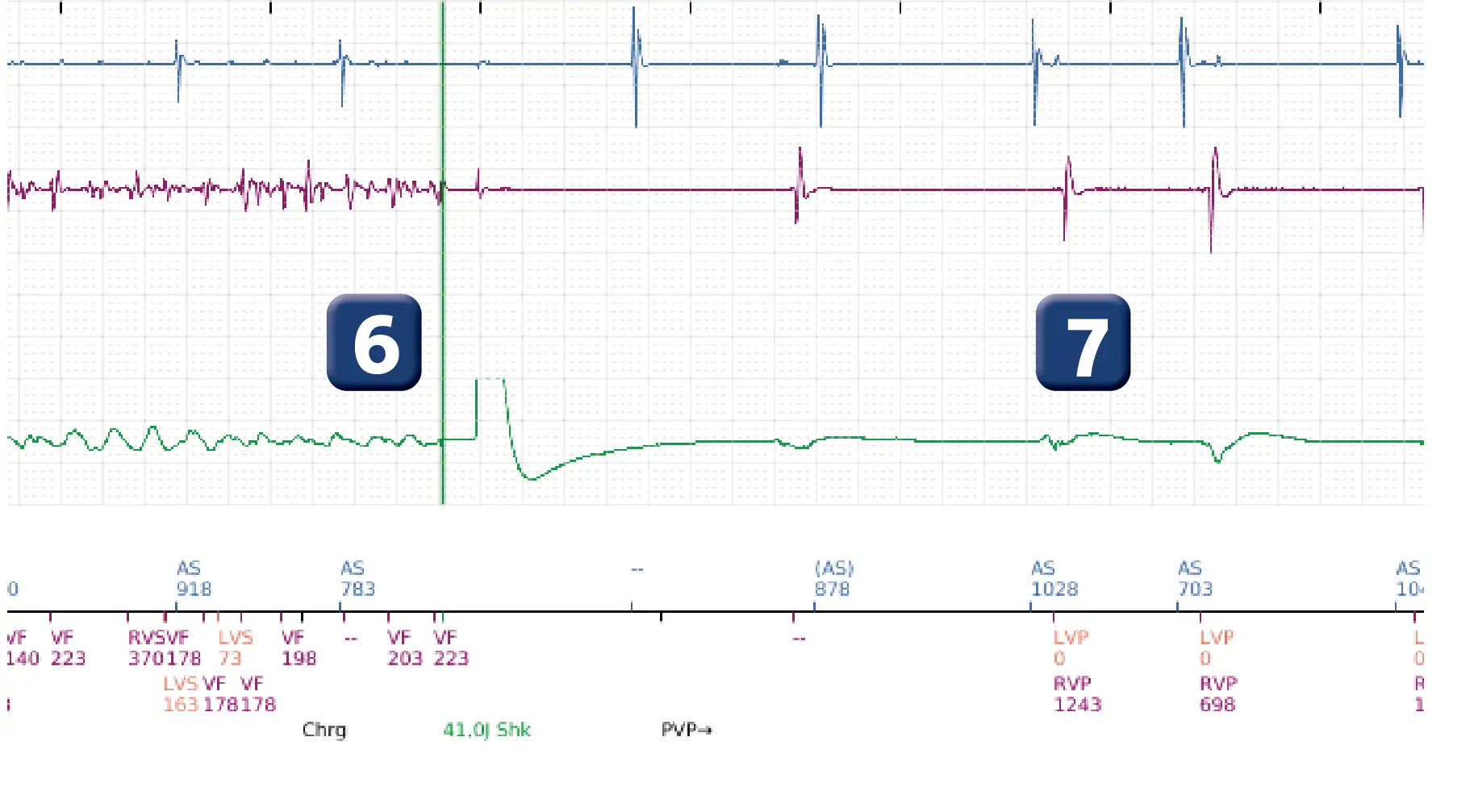 Électrogramme Boston Scientific DAI, segment 6 sur 6 — Stimulation anti-tachycardique en zone de TV et accélération en zone de FV